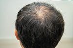 Exploring the Link Between Creatine and Hair Loss: Myths and Facts - Genetic Nutrition